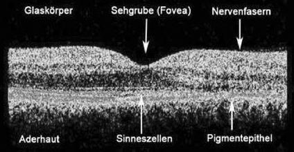 OCT-Befundbild zur Makuladegeneration
